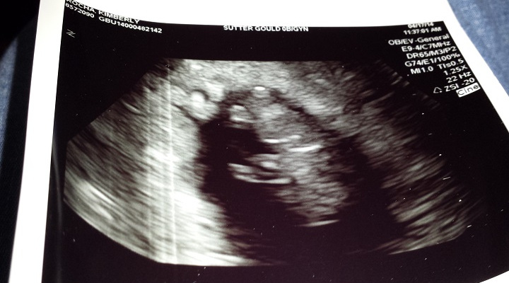 11 Week Ultrasound